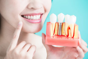 What Are Dental Implants? Here’s Everything You Need to Know